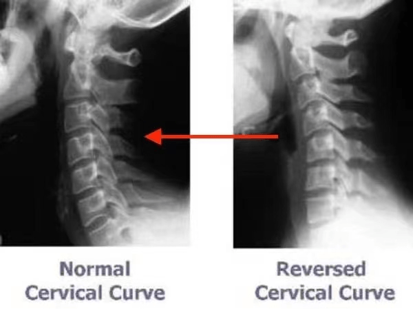 Reversed cervical discount curve pillow